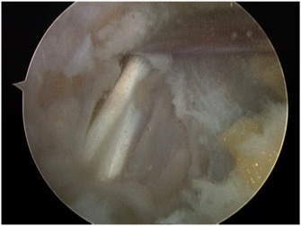 FHL Arthroscopic Release 2